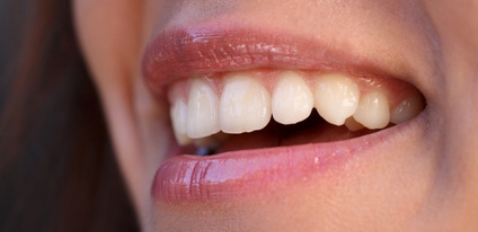Schöne Zähne durch eine kosmetische Zahnbehandlung.